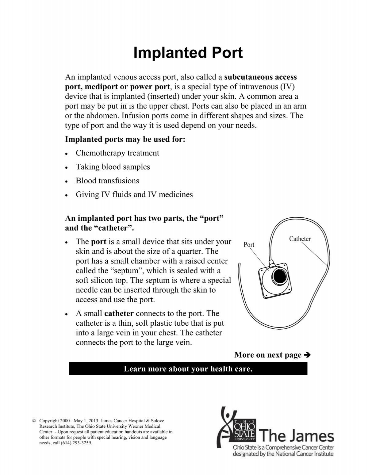 implanted port