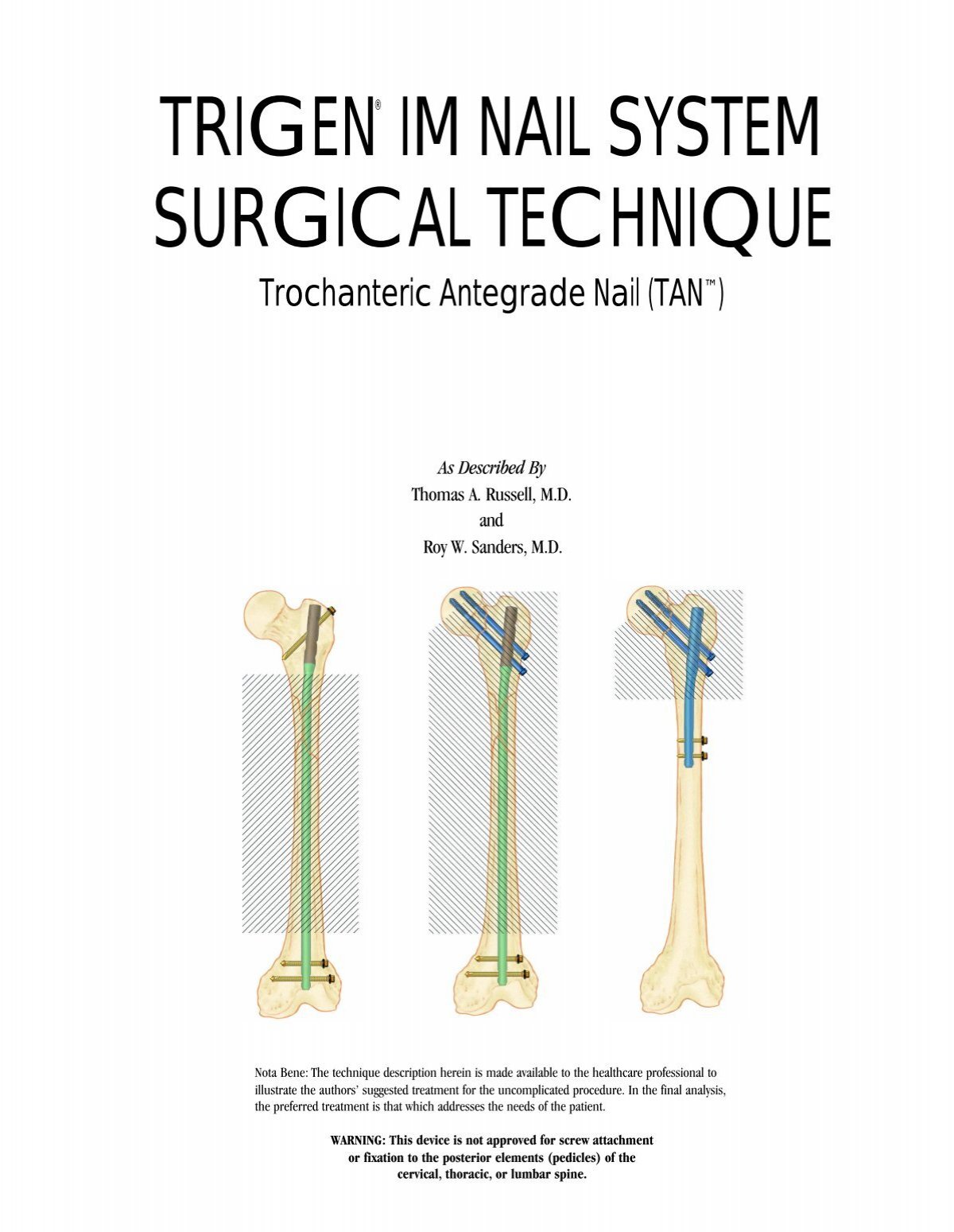 PDF] ASPECTS OF CURRENT MANAGEMENT Flexible intramedullary nails for  fractures in children | Semantic Scholar