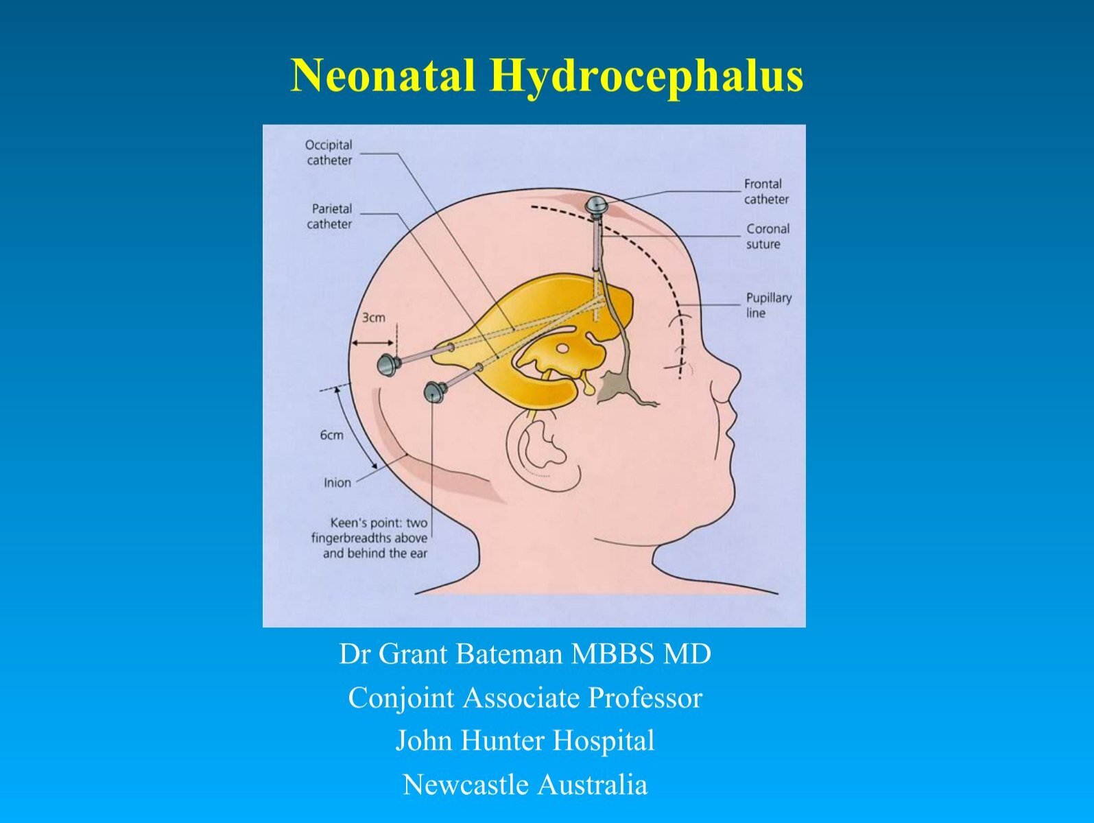 Neonatal Hydrocephalus International Hydrocephalus Imaging 9106