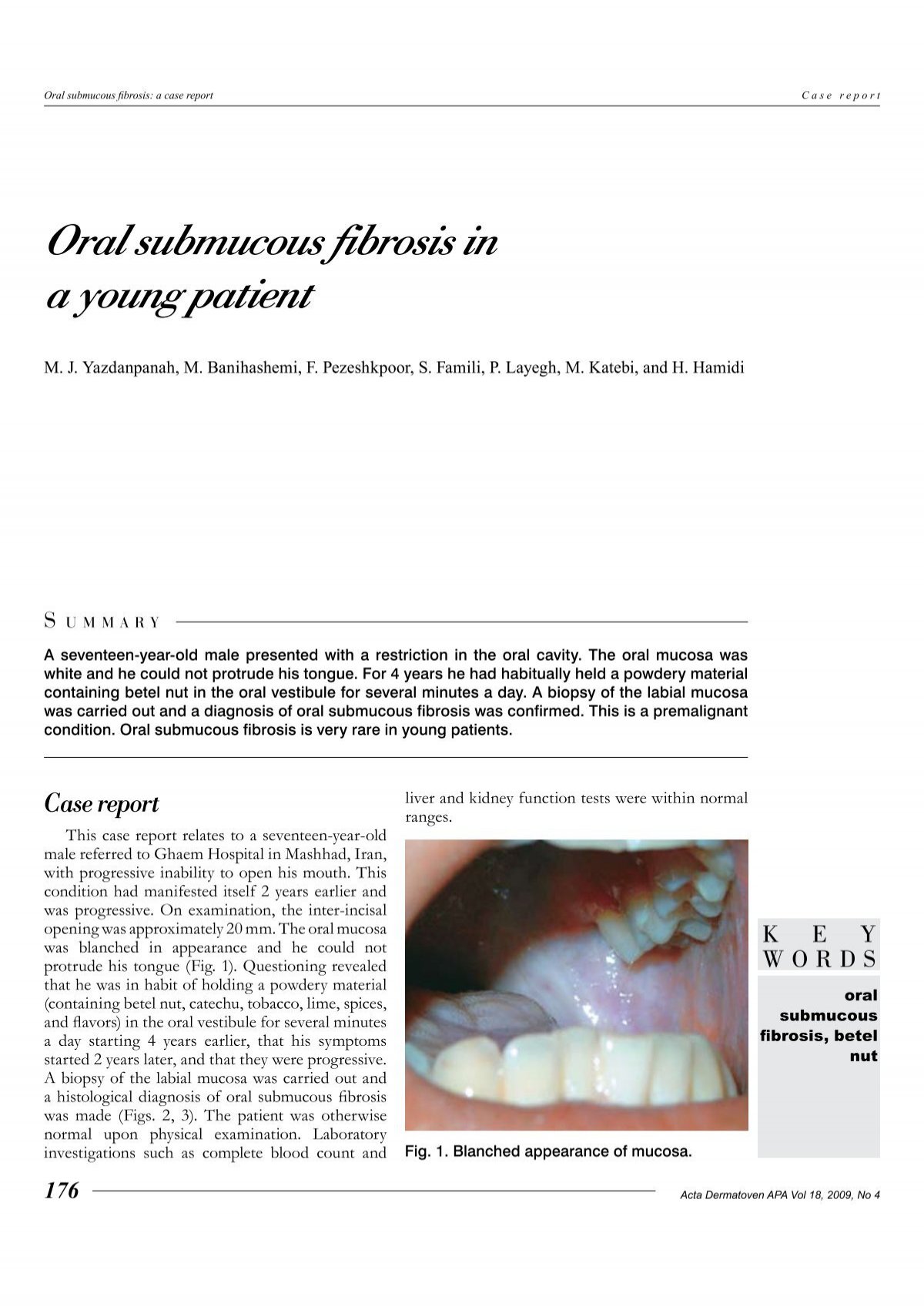 oral submucous fibrosis blanching