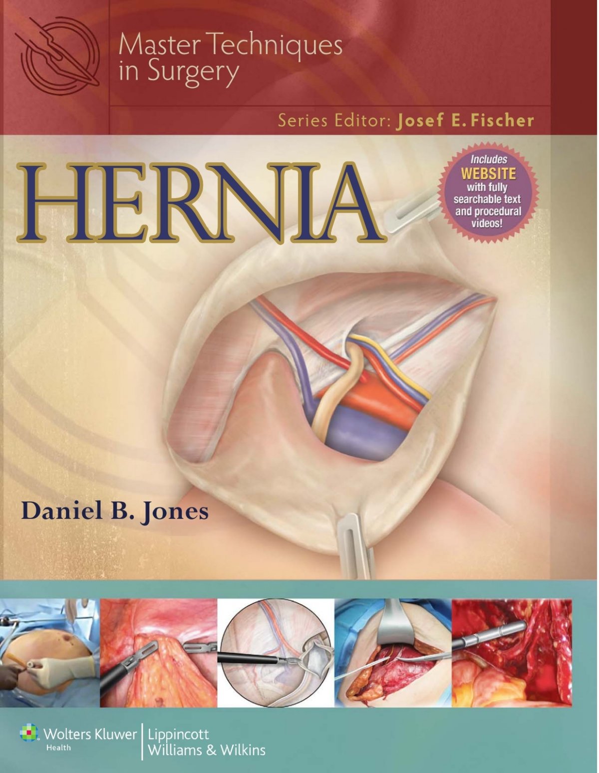 First line of Shouldice repair ( © W. Hope Textbook of Hernia)