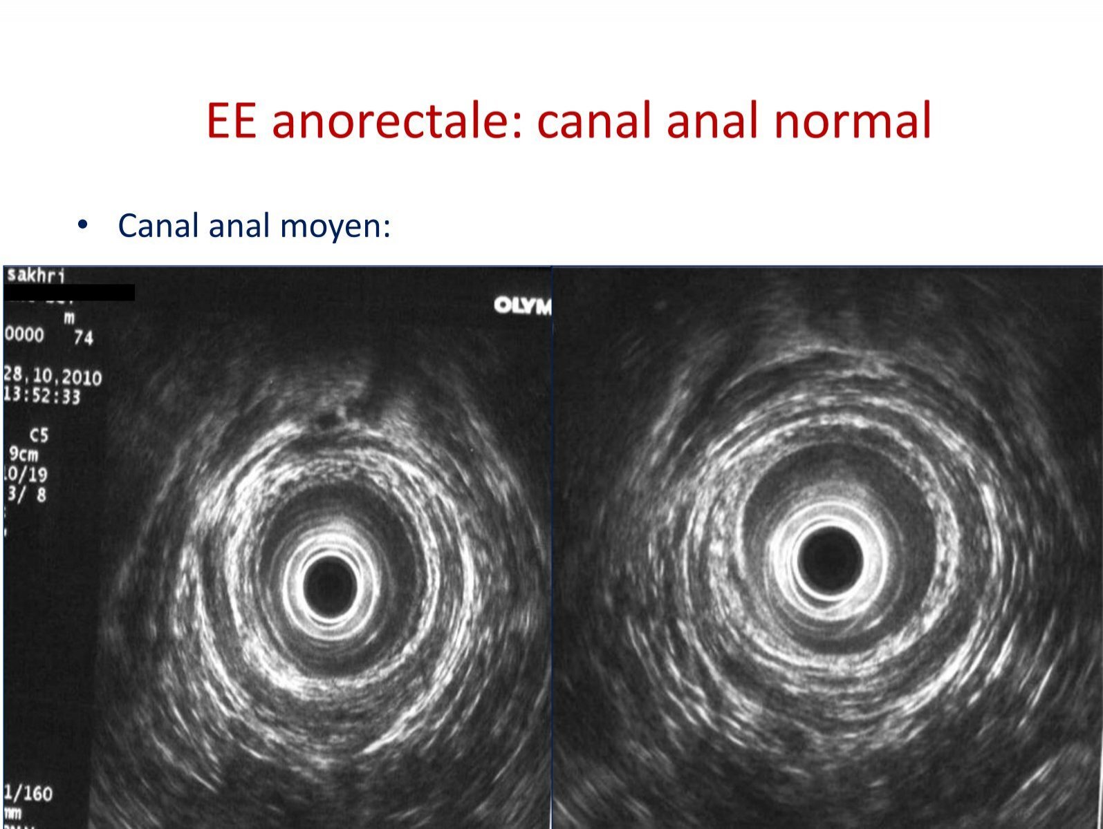 Ee Anorectale Canal Anal 